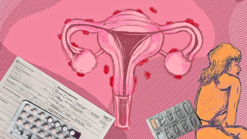 Collage Endometriose 