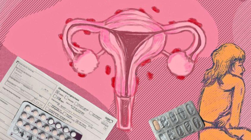 Collage Endometriose 